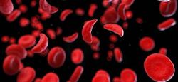 First Patient Dosed in Sickle Cell Gene Therapy Clinical Trial From Graphite Bio