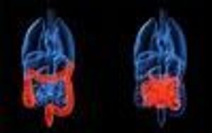 New Stem Cell Therapy May Treat Crohn's Disease