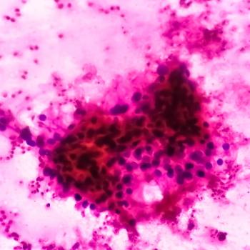 Allogeneic CAR T Therapy Controls CD70+ Clear Cell Renal Cell Carcinoma