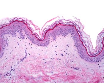 Second Gene Therapy for Epidermolysis Bullosa up for Review 