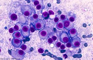 BCMA-Targeting CAR T-Cell Therapy Effective in R/R Myeloma?