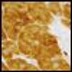 Response to Antiangiogenesis Therapy in a Patient With Advanced Adult-Type Testicular Granulosa Cell Tumor