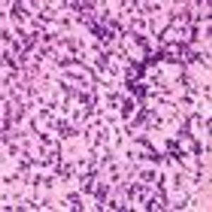 EPOCH-Rituximab Therapy Obviates Need for Radiotherapy in B-Cell Lymphoma