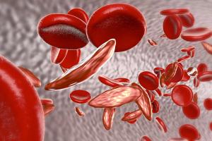Novel Gene Therapy Promising for Sickle Cell Disease