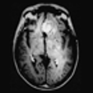 Personalized T-Cell Therapy for Brain Cancer