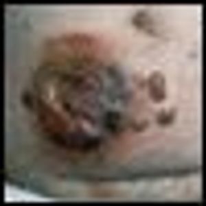 Diagnosis and Management of Mycosis Fungoides