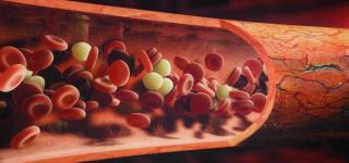 Etranacogene Dezaparvovec “Transformative” for Patients With Hemophilia B