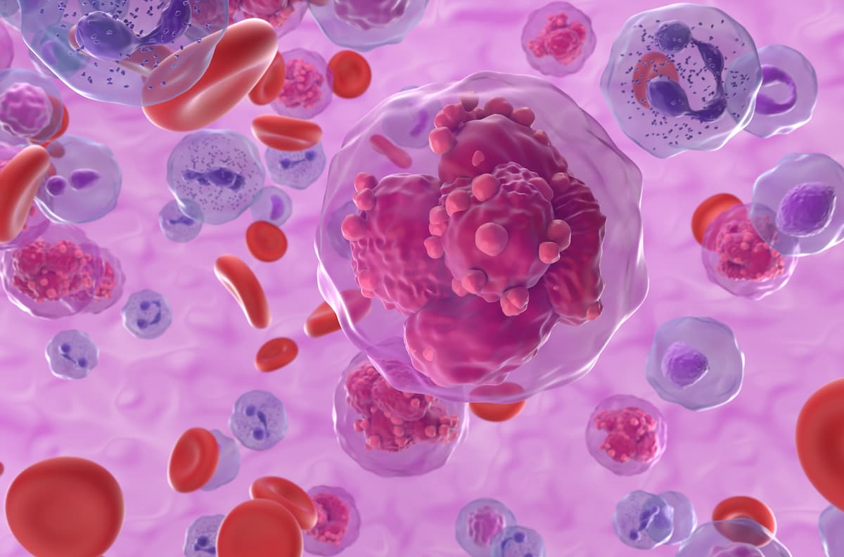 First Patient in Europe Dosed With B-cell Acute Lymphoblastic Leukemia ...