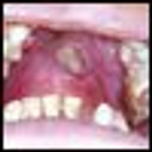 Current Management of Nasal NK/T-cell Lymphoma