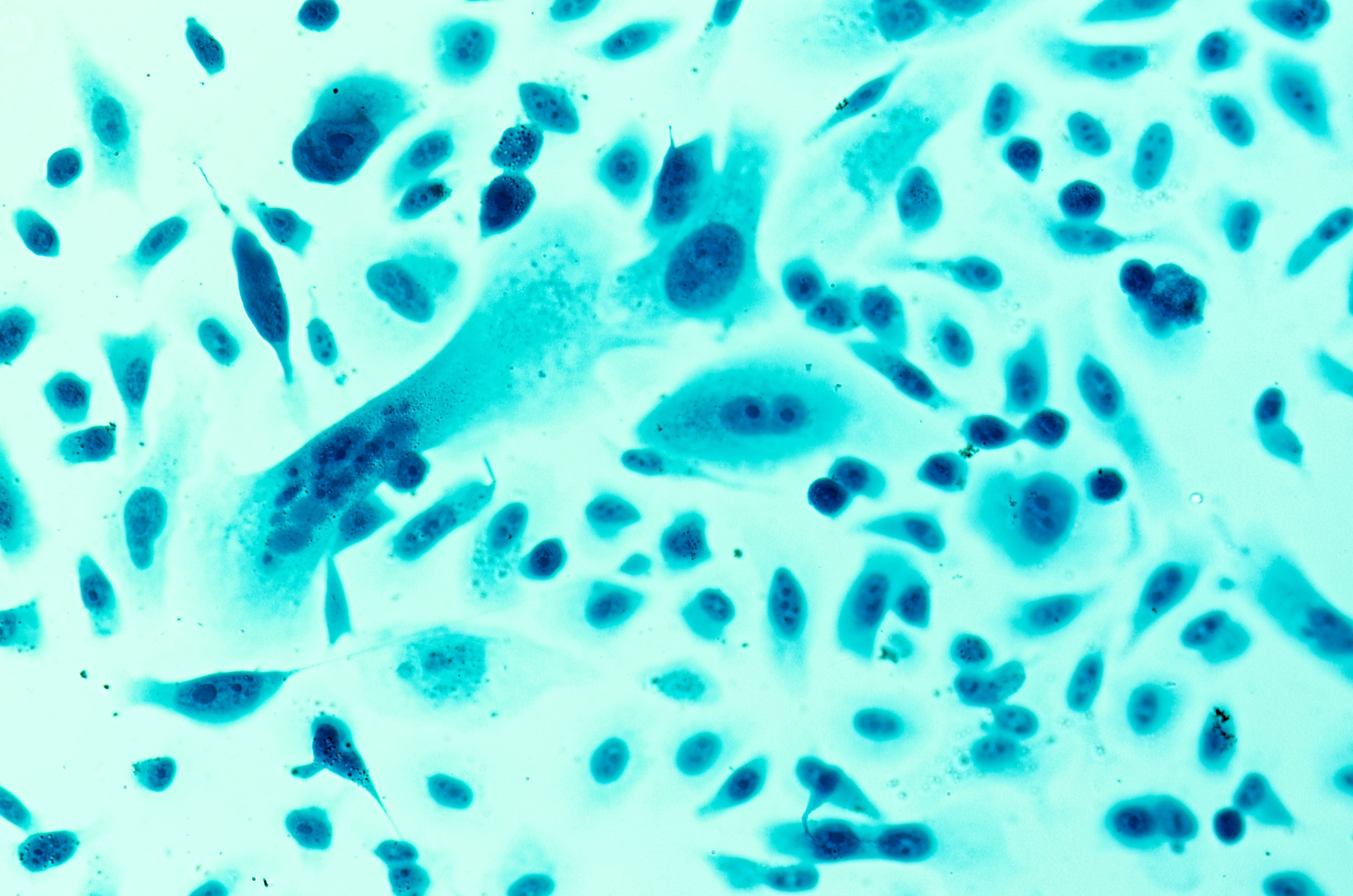 prostate cancer cells