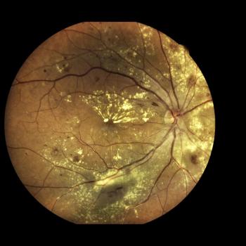 Structural Changes Support Gene Therapy's Effect on Geographic Atrophy