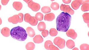 T-Cell Therapy Gets Orphan Drug Designation for AML