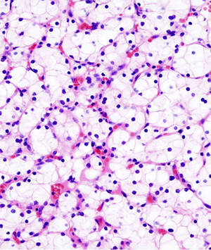 New Target Proposed for Fighting Clear Cell RCC