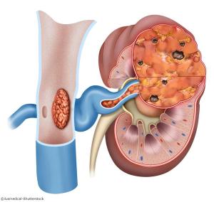 Safety of Immune Checkpoint Inhibitors With Nephrectomy in mRCC