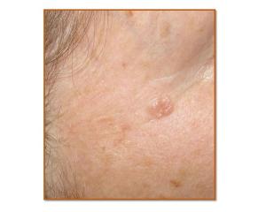 ASTRO Releases Clinical Guideline for Radiation Therapy in Treating Patients with Skin Cancer