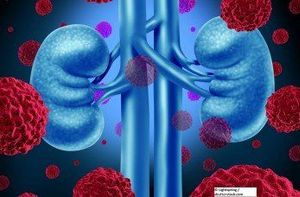 Targeted Therapy Proves Its Worth in Metastatic Kidney Cancer Patients