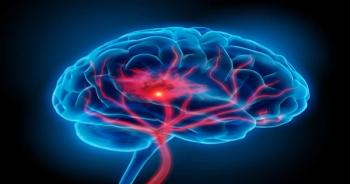 MultiStem Cell Therapy Not Superior to Placebo in Patients With Ischemic Stroke