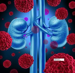 When Surgery Is Not an Option in Renal Cell Carcinoma: The Evolving Role of Stereotactic Body Radiation Therapy