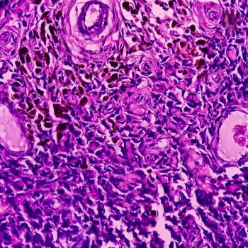 Afami-cel Prompts Antitumor Immune Response in Synovial Sarcoma, Myxoid/Round Cell Liposarcoma