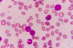 Bispecific Approach Targeting CD19 and CD22 Shows Positive Signs in B-ALL