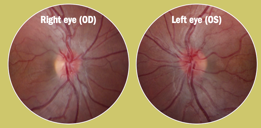 Leber hereditary optic neuropathy