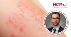 Brepocitinib Improves Cutaneous Sarcoidosis by Week 4: Aaron Mangold, MD