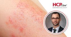 Brepocitinib Improves Cutaneous Sarcoidosis by Week 4: Aaron Mangold, MD