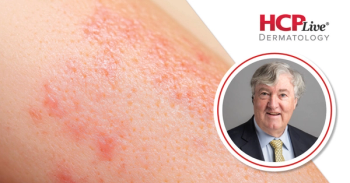 Q&A: Translating UP-AA Trial Data Into Real-World Alopecia Areata Outcomes