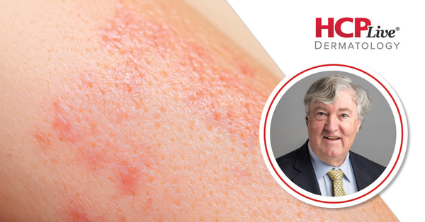 Q&A: Translating UP-AA Trial Data Into Real-World Alopecia Areata Outcomes