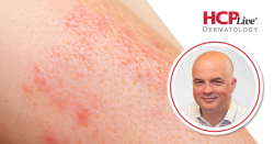 Dupilumab Impacts on Children with Atopic Dermatitis Irrespective of TCS, With Alan Irvine, MD