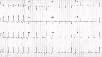 EKG strip printout