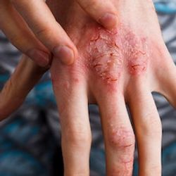 Upadacitinib Effective on for Atopic Dermatitis Patients with Concomitant Hand Eczema  