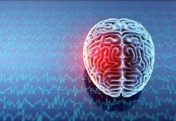 Stroke Treatment Without Thrombolytic Therapy, New Research