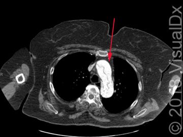 Image IQ: Ripping chest pain and leg weakness | HCPLive Clinical Forum ...