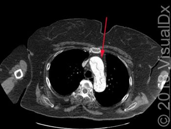 Image IQ: Ripping chest pain and leg weakness