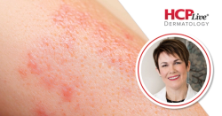 New Topline Phase 3 Data on Zasocitinib in Psoriasis, With Melinda Gooderham, MD