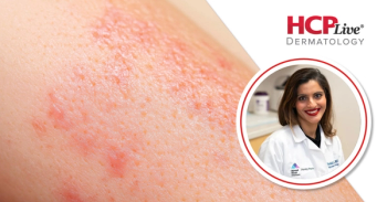 Psoriasis Awareness & Action Month: New Oral Drugs and Other Developments