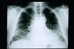FDA Grants Orphan Drug Designation to Taladegib, Potential Idiopathic Pulmonary Fibrosis Treatment