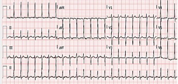 Incessant Automatic Focal Atrial Tachycardia