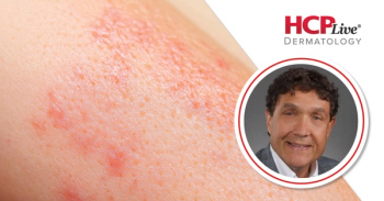 LIBERTY-CSU CUPID Findings on Dupilumab for CSU, With Jonathan Bernstein, MD