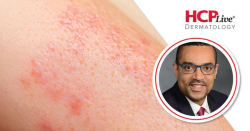 Tips for Clinicians on Keloids and Other Conditions in Dermatology, With Andrew Alexis, MD, MPH