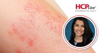 Chronic Hand Eczema: A Clinical Forum Recap, With Radhika Shah, MD