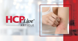 Atopic Eczema Linked to Suicidal Ideation in Global Study of 30,000 Adults