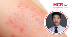 New IL-23 Inhibitor Data Highlights for Psoriasis, With Eingun James Song, MD