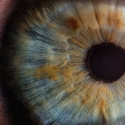 Intravitreal Dexamethasone Implant Appeared Positive for Eyes with RVO-ME