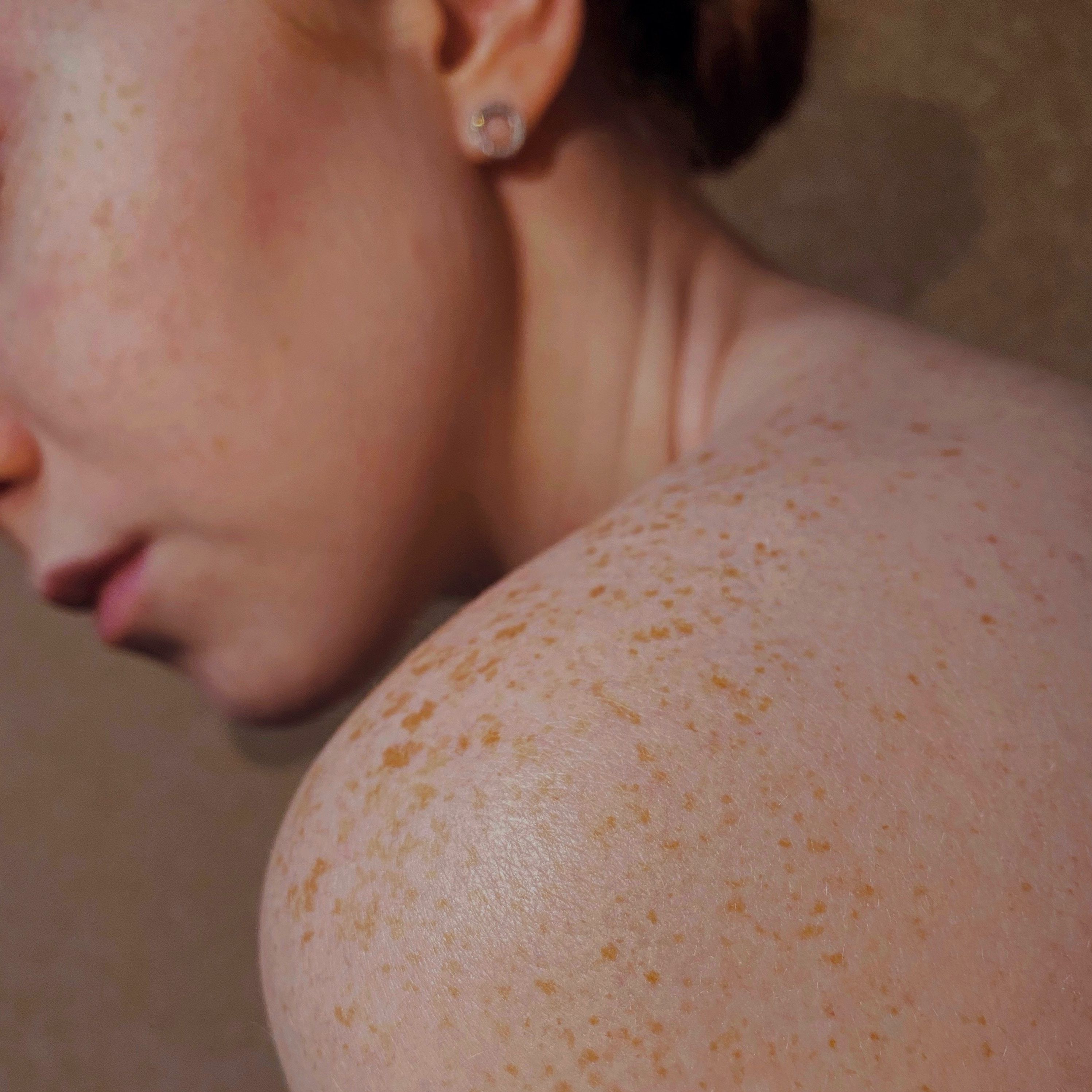 Switching IL-17 Inhibitors Could Improve Psoriasis Management