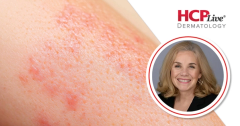 From Red-Cheeked Baby to Bulbous Nose: Rosacea, Start to Finish