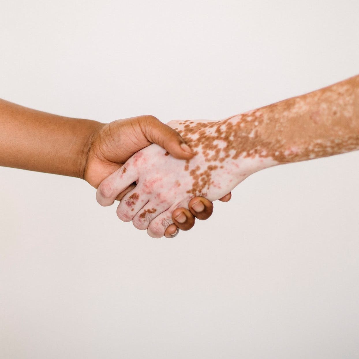 Vitiligo