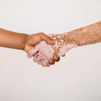 Vitiligo