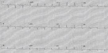 Computer Read: NSR at 86, marked RAD, low voltage, RBBB. | Credit: Brady Pregerson, MD